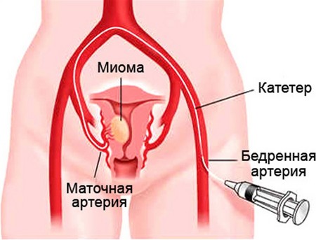 Маточная артерия 