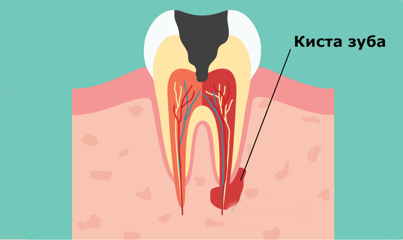 Лечение кисты зуба: эффективные методы и рекомендации